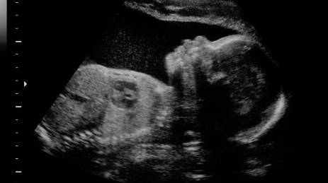 Vegas Baby 4D Ultrasound Packages